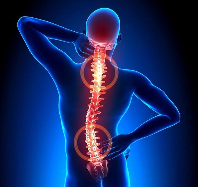 Η οστεοχόνδρωση της σπονδυλικής στήλης ως αιτία του πόνου στην πλάτη