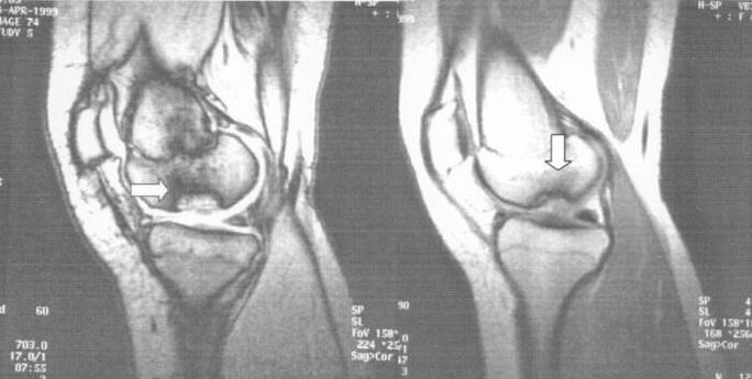 Ακτινογραφία οστεοχονδρίτιδας στην άρθρωση του γόνατος
